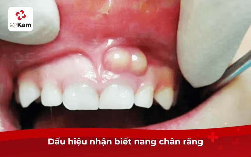 Dấu hiệu nhận biết nang chân răng