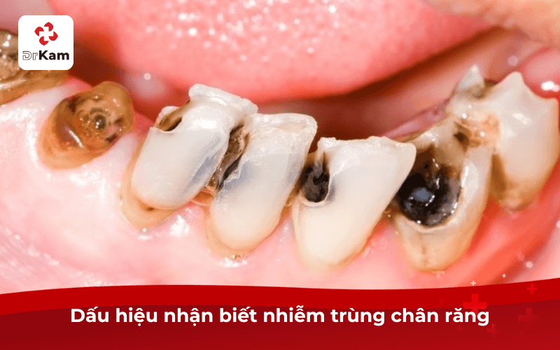 Tôi bị nhiễm trùng chân răng phải làm sao? Hậu quả và cách xử lý dứt điểm 4 Dấu hiệu nhận biết nhiễm trùng chân răng