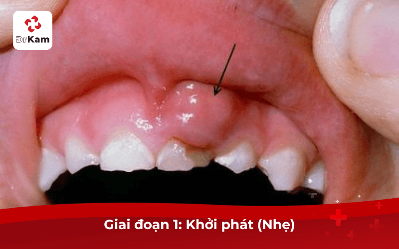 Review hình ảnh sưng mộng răng theo từng giai đoạn cần biết 6 Sưng Mộng Răng Giai Đoạn 1