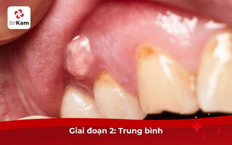 Review hình ảnh sưng mộng răng theo từng giai đoạn cần biết 7 Sưng Mộng Răng Giai Đoạn 2