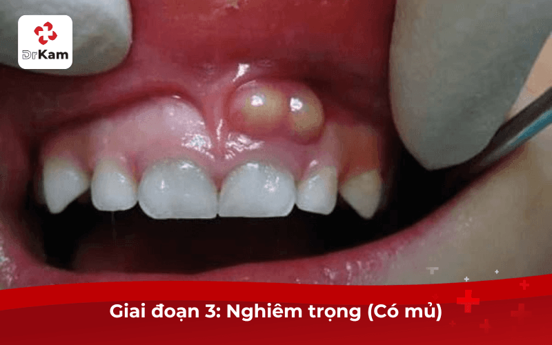 Review hình ảnh sưng mộng răng theo từng giai đoạn cần biết 8 Sưng Mộng Răng Giai Đoạn 3