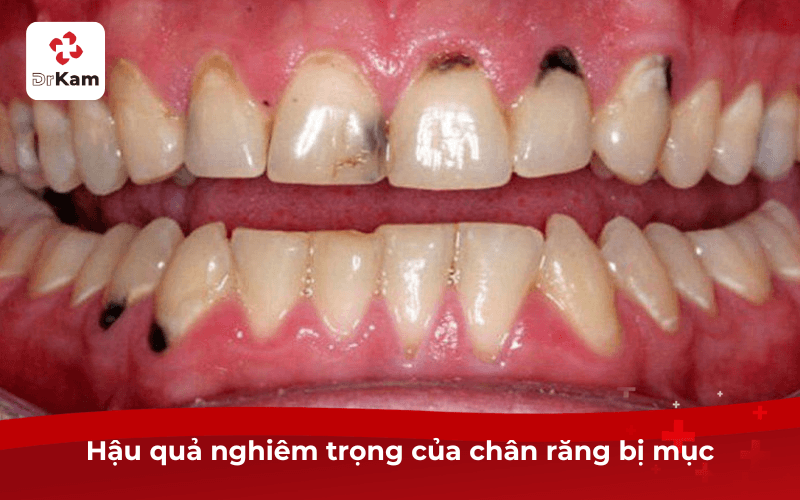 Hậu quả nghiêm trọng của chân răng bị mục