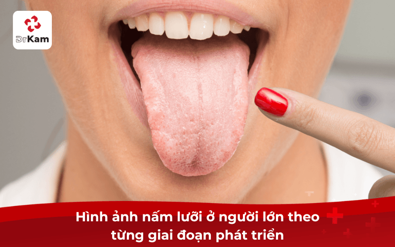 Hình ảnh nấm lưỡi ở người lớn theo từng giai đoạn phát triển
