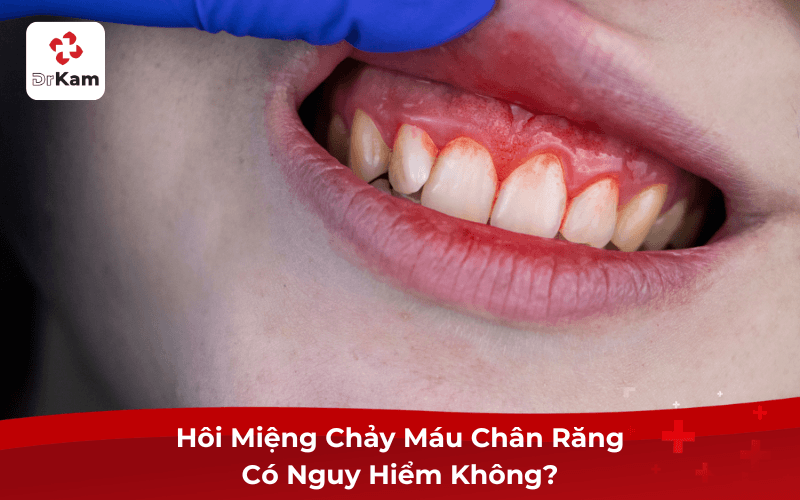 Tôi bị hôi miệng chảy máu chân răng phải làm sao? Nguyên nhân, dấu hiệu và cách xử lý 4 Hôi Miệng Chảy Máu Chân Răng Có Nguy Hiểm Không?