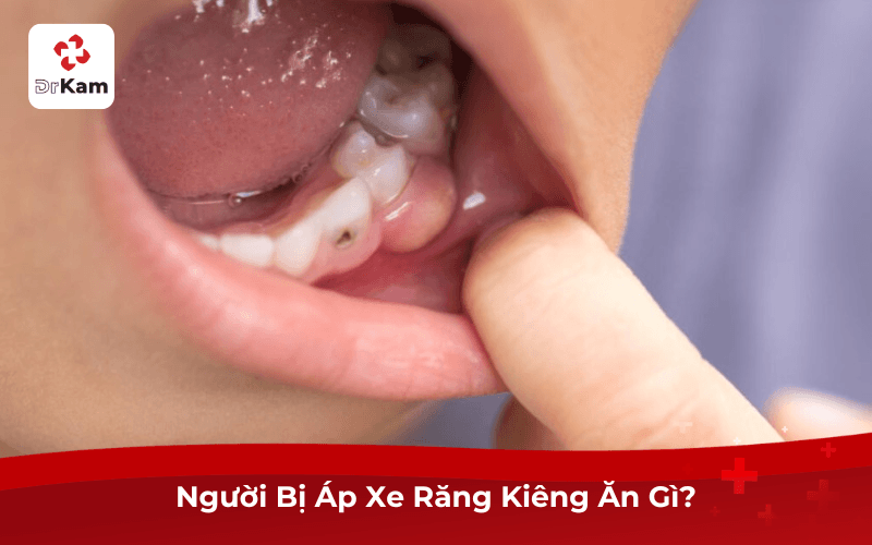 Người Bị Áp Xe Răng Kiêng Ăn Gì?