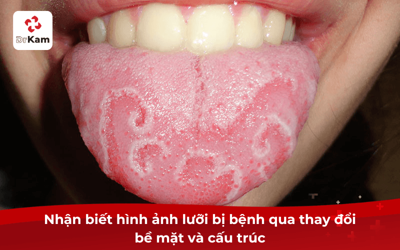 Thực tế hình ảnh lưỡi bị bệnh cha mẹ cần biết để xử lý kịp thời cho bé 6 Nhận biết hình ảnh lưỡi bị bệnh qua thay đổi bề mặt và cấu trúc