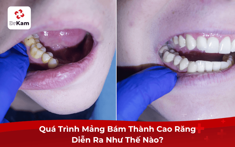 Bao lâu mảng bám thành cao răng? 4 yếu tố ảnh hưởng và cách ngăn ngừa cao răng 4 Bao lâu mảng bám thành cao răng?