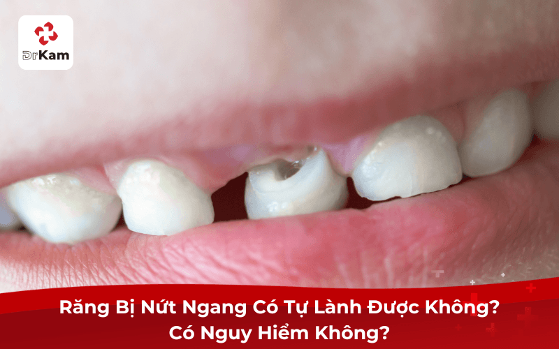 Răng Bị Nứt Ngang Có Tự Lành Được Không? Có Nguy Hiểm Không?