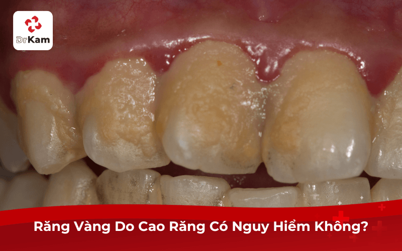 Răng Vàng Do Cao Răng Có Nguy Hiểm Không?