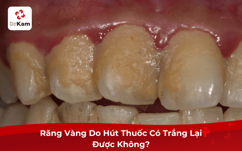 Tôi bị răng vàng do hút thuốc lá? 10 cách khắc phục hiệu quả tại nhà và nha khoa 4 Răng Vàng Do Hút Thuốc Có Trắng Lại Được Không?