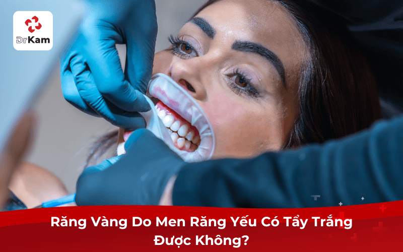 Răng Vàng Do Men Răng Yếu Có Tẩy Trắng Được Không?