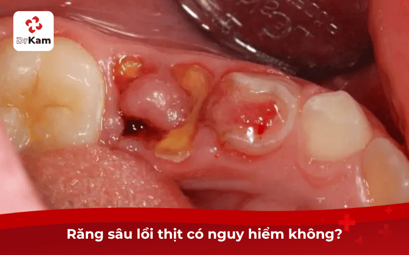 Răng sâu lồi thịt có nguy hiểm không?