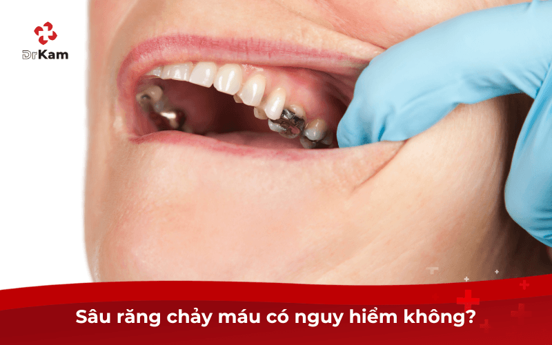 Sâu răng chảy máu có nguy hiểm không?