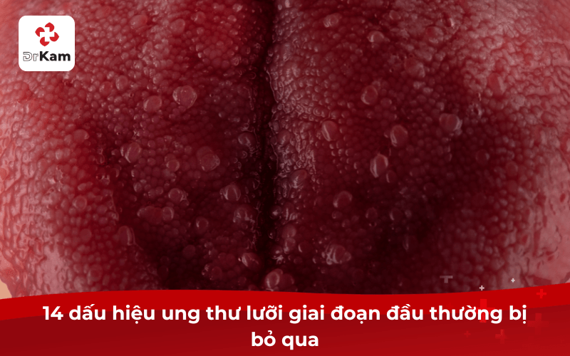 Ung thư lưỡi: Dấu hiệu, nguyên nhân, điều trị và cách tự kiểm tra 5 14 dấu hiệu ung thư lưỡi giai đoạn đầu thường bị bỏ qua