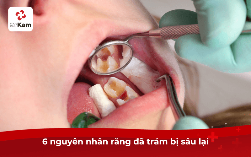 6 nguyên nhân răng đã trám bị sâu lại