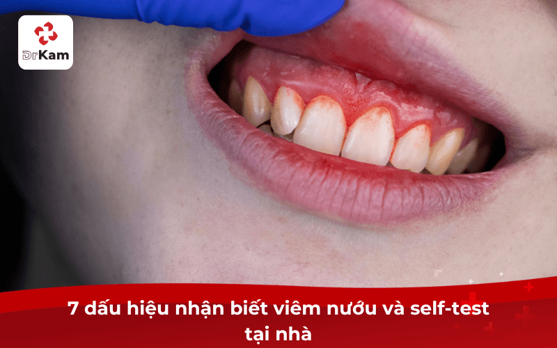 7 dấu hiệu nhận biết viêm nướu và self-test tại nhà