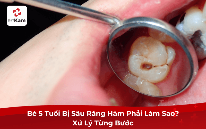 Bé 5 Tuổi Bị Sâu Răng Hàm Phải Làm Sao? Xử Lý Từng Bước