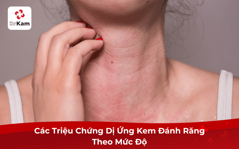 Các Triệu Chứng Dị Ứng Kem Đánh Răng Theo Mức Độ