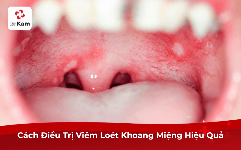Viêm Loét Khoang Miệng: Nguyên Nhân, Dấu Hiệu Và Cách Điều Trị Hiệu Quả 4 Cách Điều Trị Viêm Loét Khoang Miệng Hiệu Quả