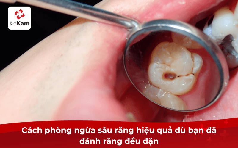 Cách phòng ngừa sâu răng hiệu quả dù bạn đã đánh răng đều đặn