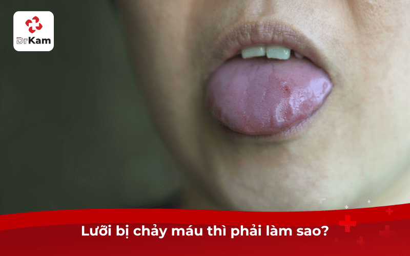 Lưỡi bị chảy máu thì phải làm sao? Quy trình xử lý và khi nào cần đi khám 4 Lưỡi bị chảy máu thì phải làm sao?