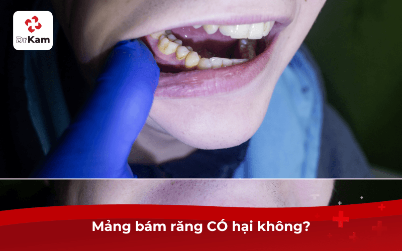 Mảng bám răng CÓ hại không?