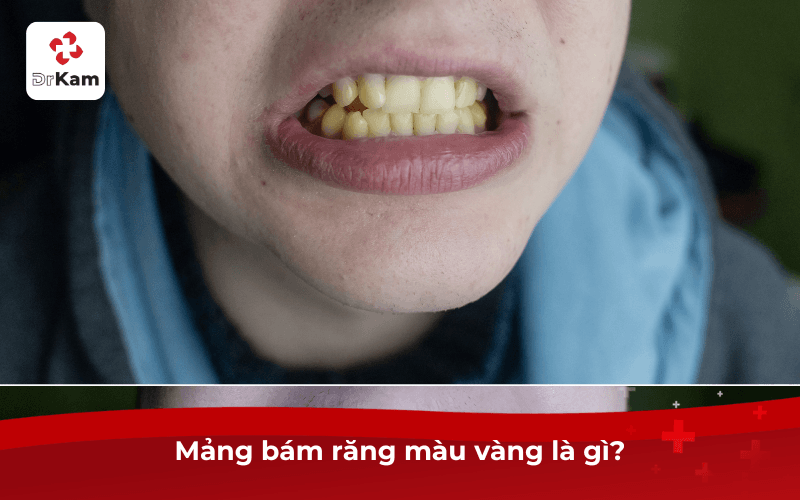 Mảng Bám Răng Màu Vàng: Nguyên Nhân, Tác Hại Và 8 Cách Xử Lý 4 Mảng bám răng màu vàng là gì?