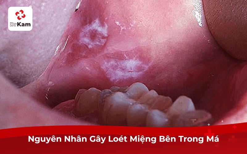 Loét Miệng Bên Trong Má: Nguyên Nhân, Cách Chữa & Phòng Ngừa Tái Phát 4 Nguyên Nhân Gây Loét Miệng Bên Trong Má