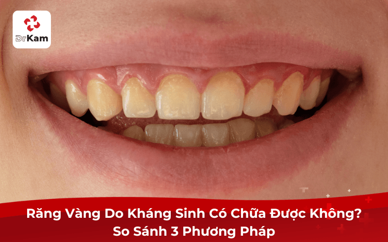 Răng Vàng Do Kháng Sinh: Nguyên Nhân, 4 Độ Nhiễm Và Cách Trị Mới Nhất 2026 4 Răng Vàng Do Kháng Sinh Có Chữa Được Không? So Sánh 3 Phương Pháp