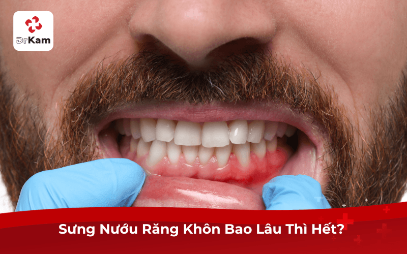 Sưng Nướu Răng Khôn Bao Lâu Thì Hết? 