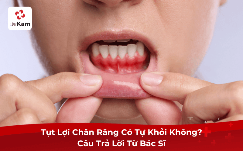 Tụt Lợi Chân Răng Có Tự Khỏi Không? Câu Trả Lời Từ Bác Sĩ