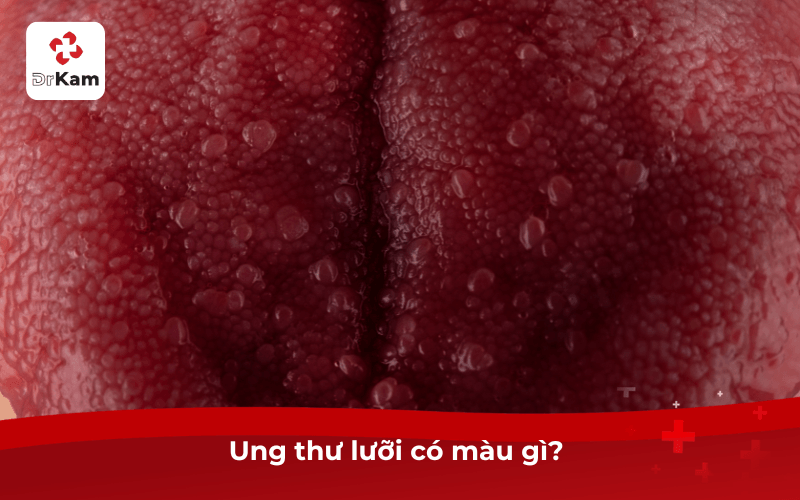 Ung thư lưỡi có màu gì? 