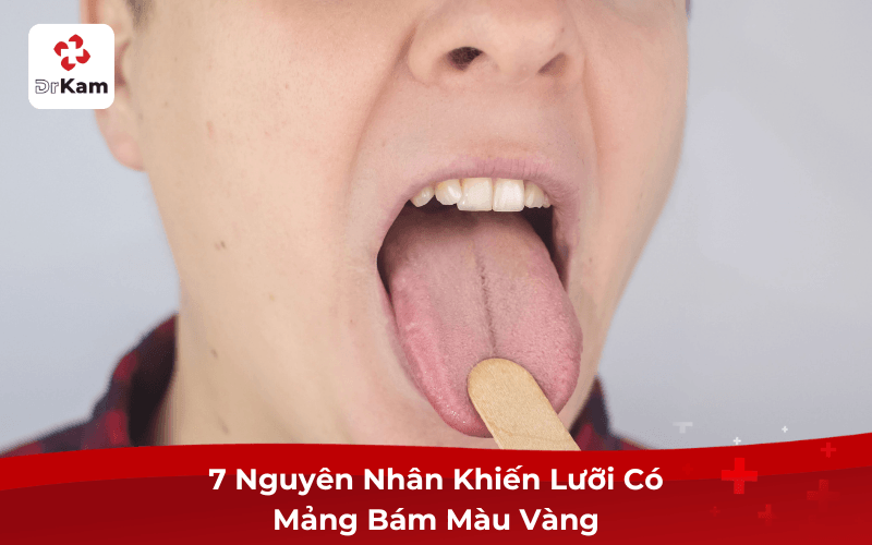 7 Nguyên Nhân Khiến Lưỡi Có Mảng Bám Màu Vàng