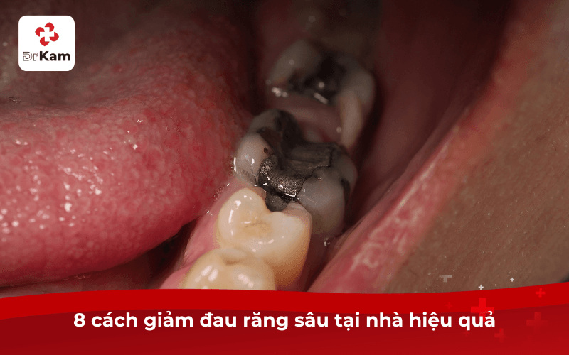 8 Cách giảm đau răng sâu tại nhà nhanh nhất 4 8 cách giảm đau răng sâu tại nhà hiệu quả