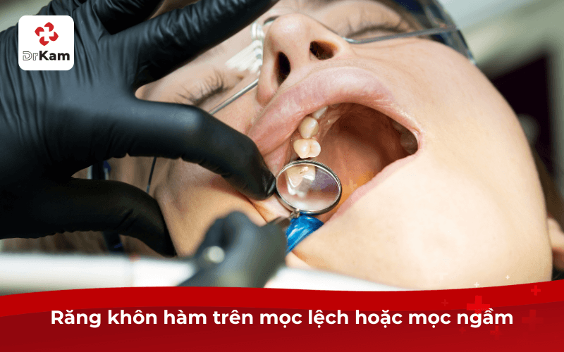 Răng khôn hàm trên mọc lệch hoặc mọc ngầm