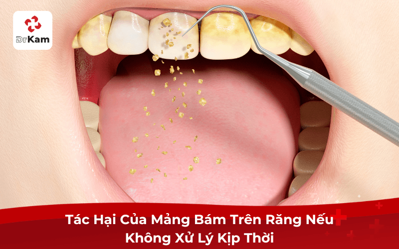 Tác Hại Của Mảng Bám Trên Răng Nếu Không Xử Lý Kịp Thời