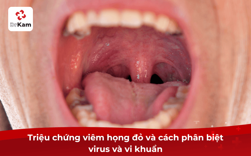 Triệu chứng viêm họng đỏ và cách phân biệt virus và vi khuẩn