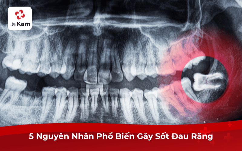 5 Nguyên Nhân Phổ Biến Gây Sốt Đau Răng