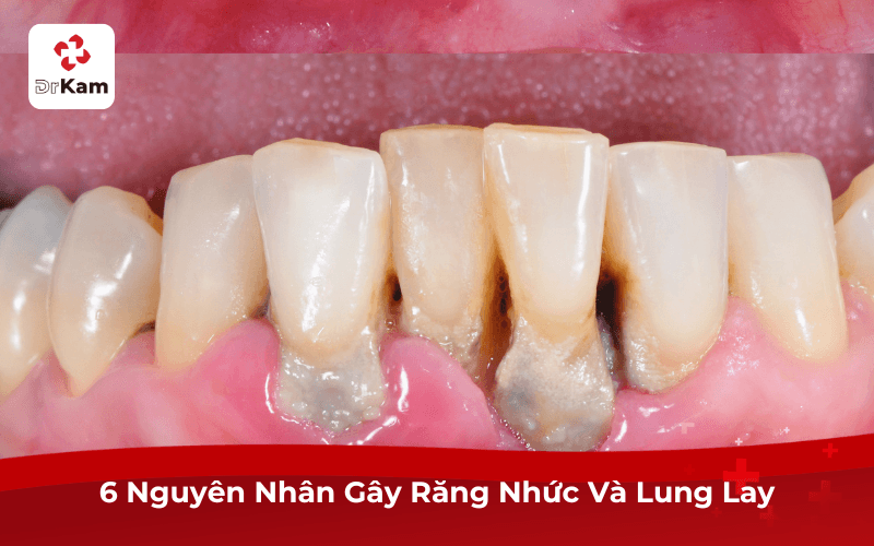 6 Nguyên Nhân Gây Răng Nhức Và Lung Lay