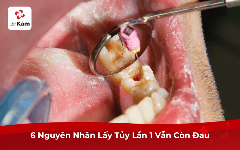 6 Nguyên Nhân Lấy Tủy Răng Lần 1 Vẫn Còn Đau