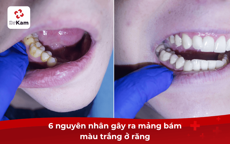6 nguyên nhân gây ra mảng bám màu trắng ở răng