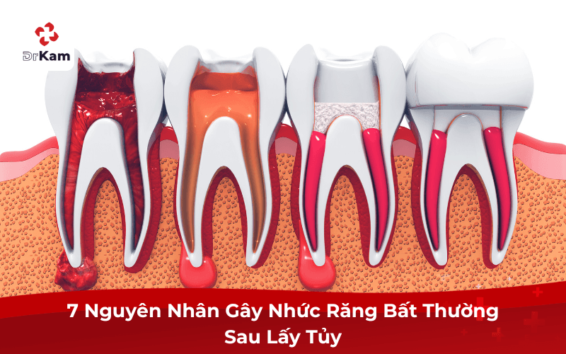 7 Nguyên Nhân Gây Nhức Răng Sau Khi Lấy Tủy