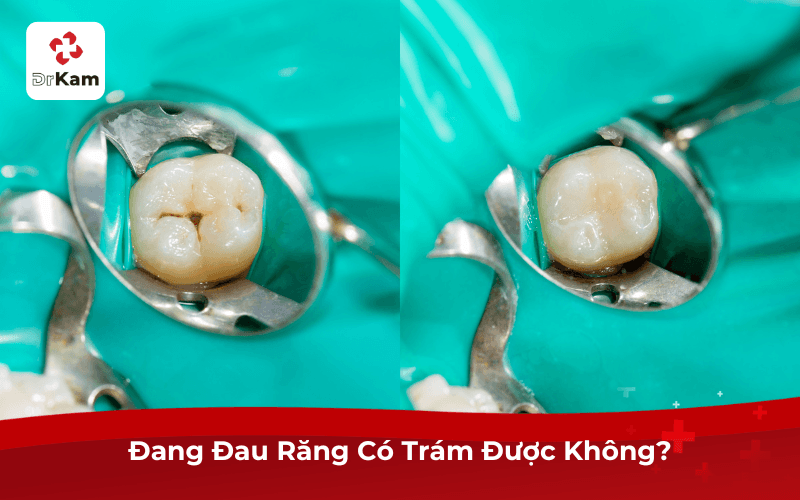 Đang Đau Răng Có Trám Được Không