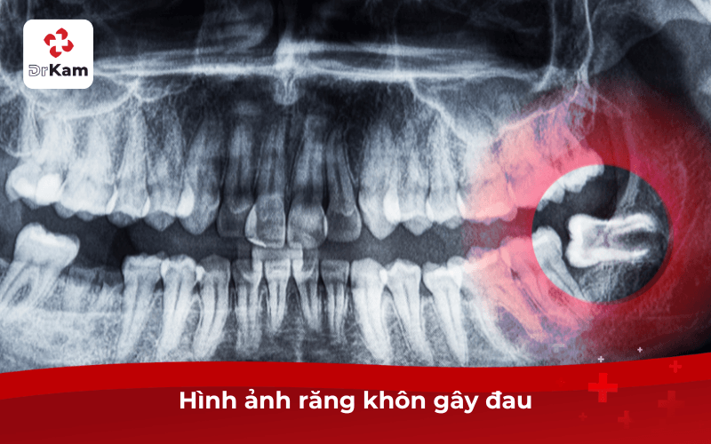 Hình ảnh răng khôn gây đau