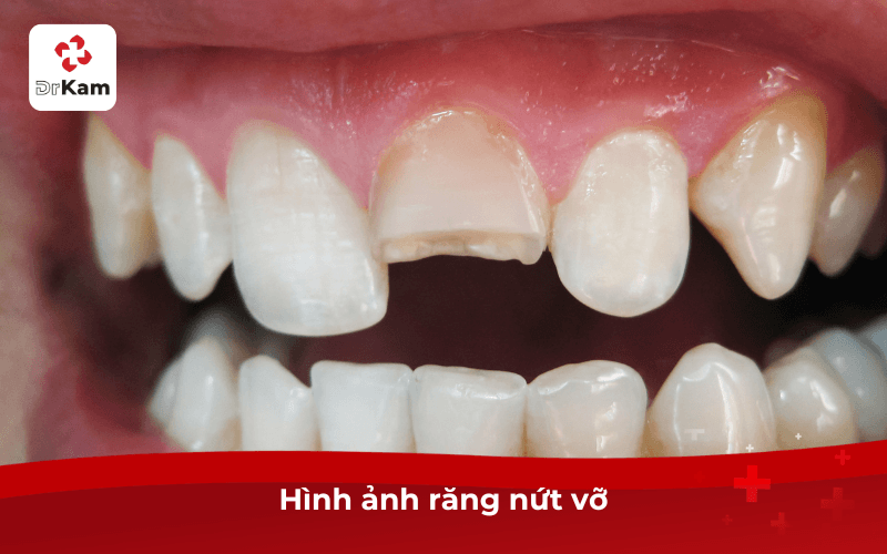Hình ảnh răng nứt vỡ