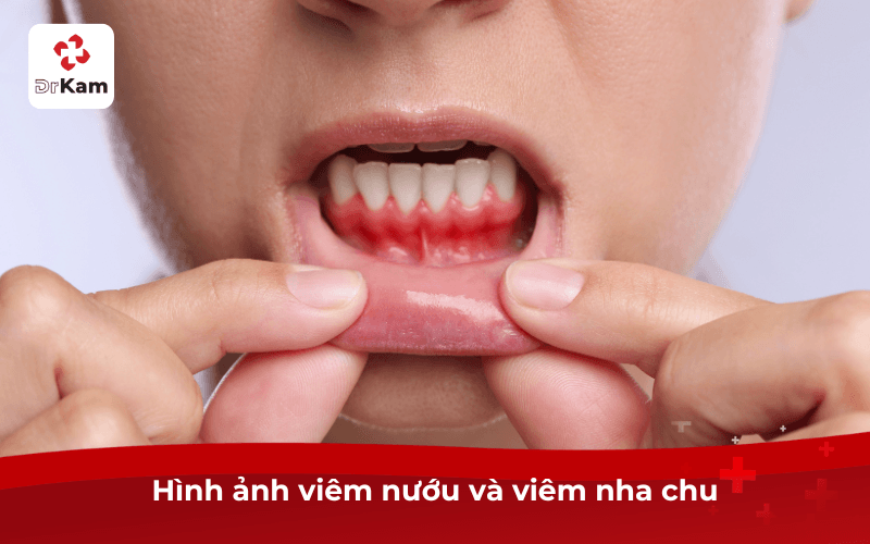 Hình ảnh đau răng viêm nướu và viêm nha chu