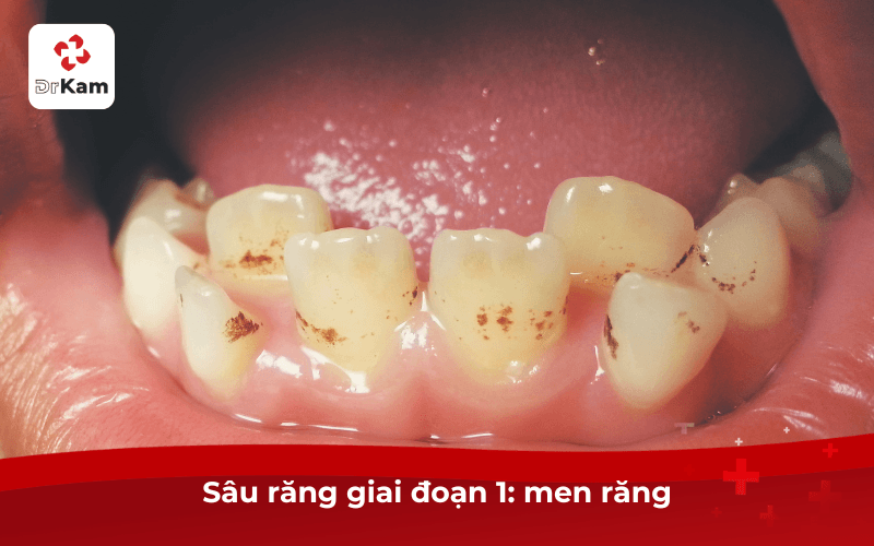 Sâu răng giai đoạn 1: men răng