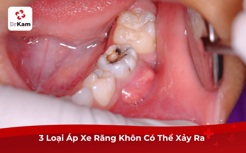 3 Loại Áp Xe Răng Khôn Có Thể Xảy Ra 
