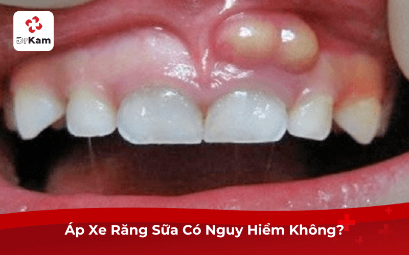 Áp Xe Răng Sữa Có Nguy Hiểm Không?