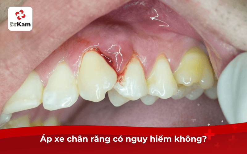 Áp xe chân răng có nguy hiểm không?